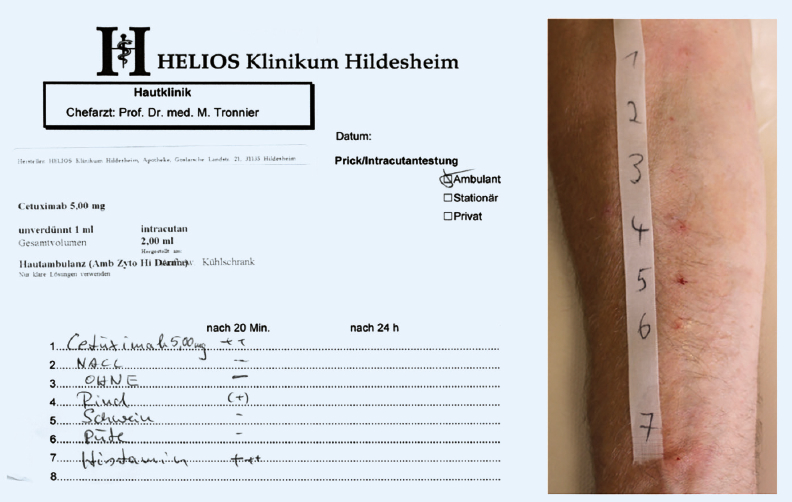 Falldarstellung: Alpha-Galaktose-Syndrom – »die verzögerte Fleischallergie«