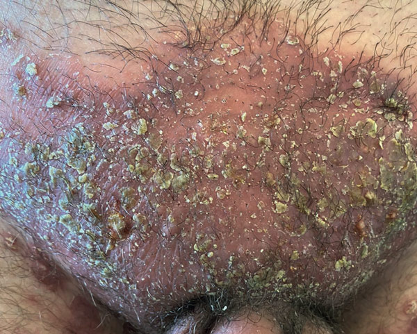 Hätten Sie daran gedacht? Trichophytie mit Trichophyton mentagrophytes Genotyp VII (Thailandpilz)