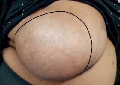 Schwangerschaftsassoziiertes triple-negatives Mamma- karzinomin einer großen Zyste der rechten Brust – ein Fallbericht und Literaturübersicht