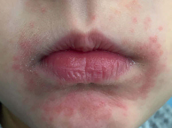 Kinderdermatologie: Aus der Praxis für die Praxis – Teil 28