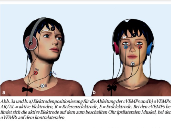 Schwindeldiagnostik in der HNO-ärztlichen Praxis. Teil 8: Diagnostik der Otolithenorgane – Abschnitt 2