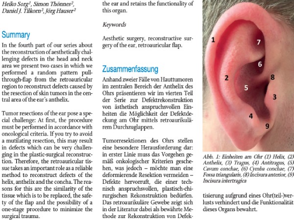 Rekonstruktion schwieriger ästhetischer Einheiten – Teil 4: Deckung zentraler Ohrdefekte mittels retroaurikulärem Durchzuglappen