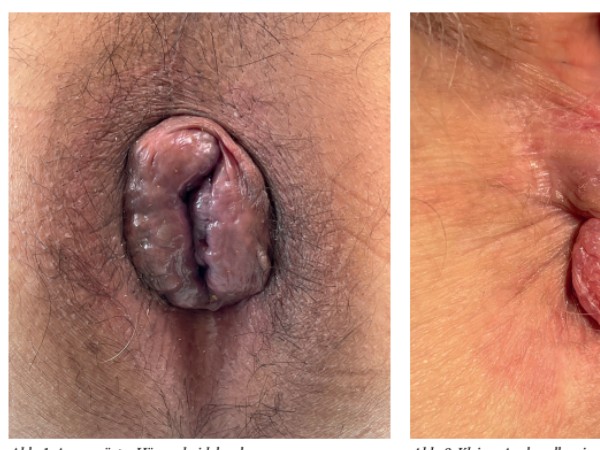 Es sind nicht immer Hämorrhoiden – die wichtigsten dermatologischen Differenzialdiagnosen zum Hämorrhoidalleiden