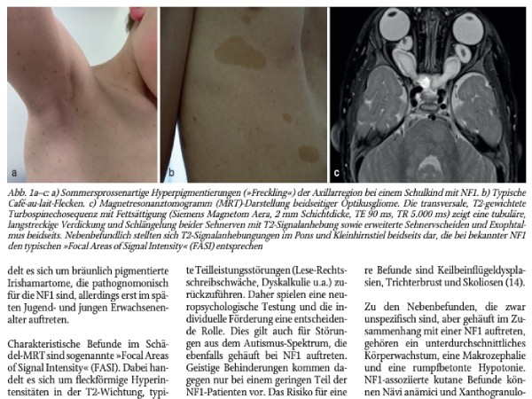 Neurofibromatose Typ 1 (NF1) – klinisches Bild und neue Therapieansätze