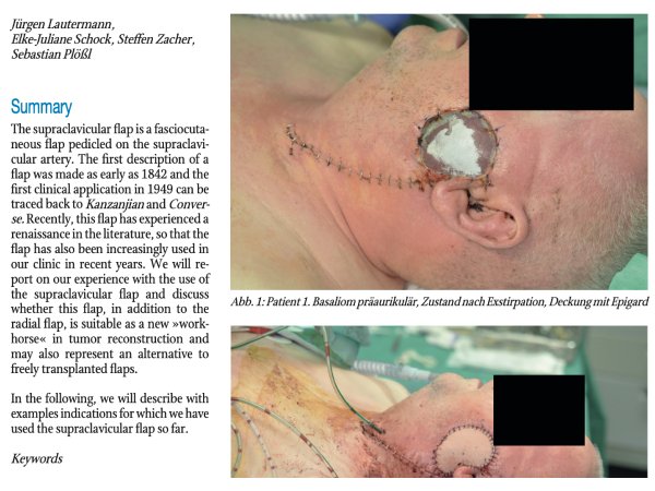 Anwendungsmöglichkeiten des Supraclavicularlappens – ein Erfahrungsbericht
