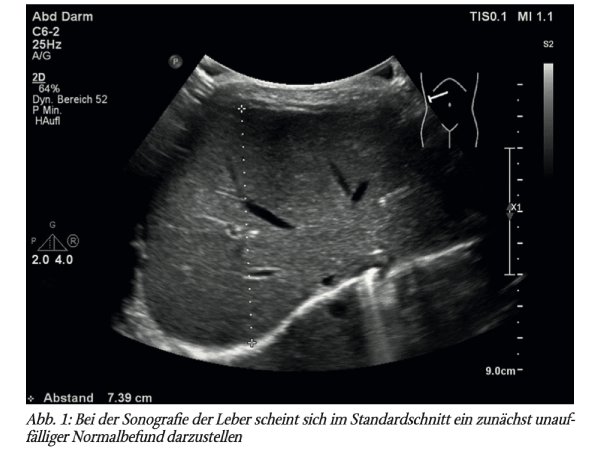 Pädiatrische HNO: Diagnose eines Hepatoblastoms im Rahmen stationärer Betreuung bei RSV-Bronchiolitis