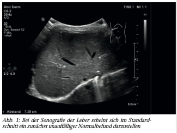 Pädiatrische HNO: Diagnose eines Hepatoblastoms im Rahmen stationärer Betreuung bei RSV-Bronchiolitis