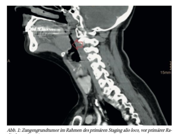 HPV-positives Oropharynxkarzinom