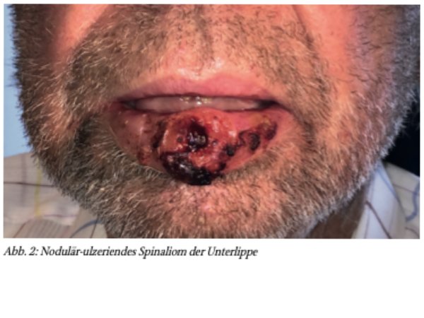 Karzinome der Haut im Kopf-Hals-Bereich – Update zu aktuellen Therapieoptionen