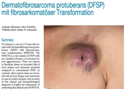 Dermatofibrosarcoma protuberans (DFSP) mit fibrosarkomatöser Transformation