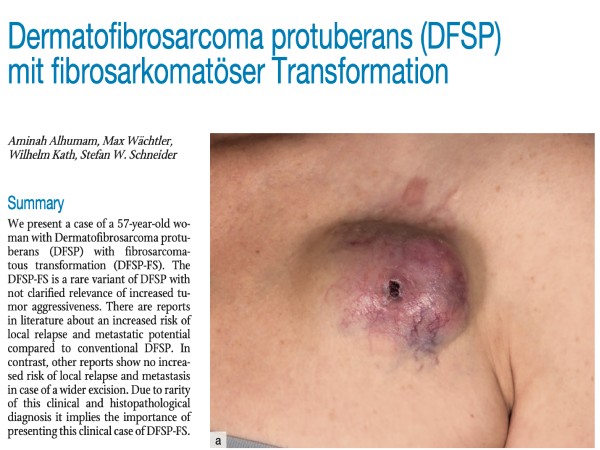 Dermatofibrosarcoma protuberans (DFSP) mit fibrosarkomatöser Transformation