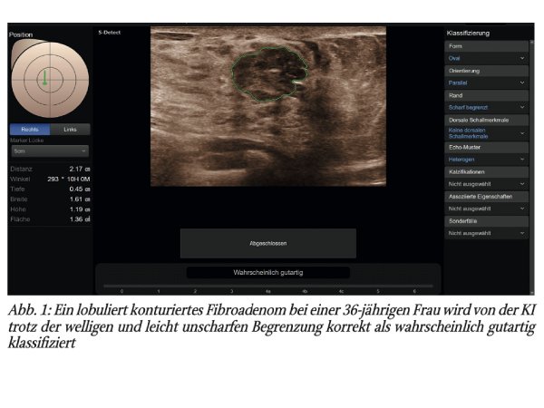 Künstliche Intelligenz (KI) beim handgeführten Brustultraschall