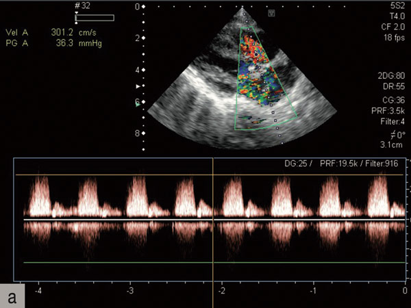 Pädiatrische HNO: Schwere RSV-Bronchopneumonie bei einem fast 2-jährigen Hochrisikopatienten ohne empfohlene Prophylaxe