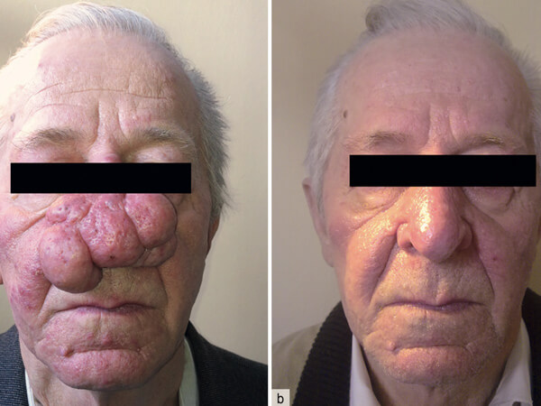 Rhinophym