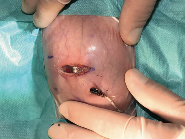 Chirurgisches Management der nekrotisierenden Enterokolitis (NEC) – Laparotomie oder Drainage?