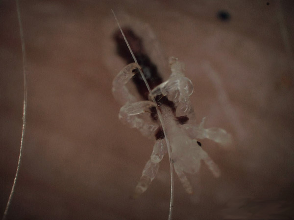 Parasitäre Hauterkrankungen in der kinderärztlichen und dermatologischen Praxis: Pedikulosen