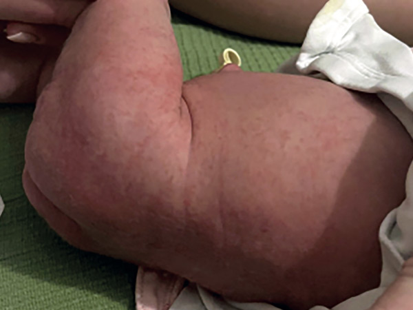 Seltener Fall einer neonatalen Scharlacherkrankung nach Hausgeburt
