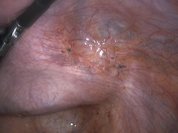 Endometriose – ein Update