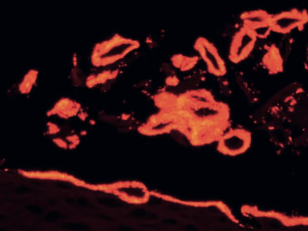 Bakterielle Vaginose: ein Update