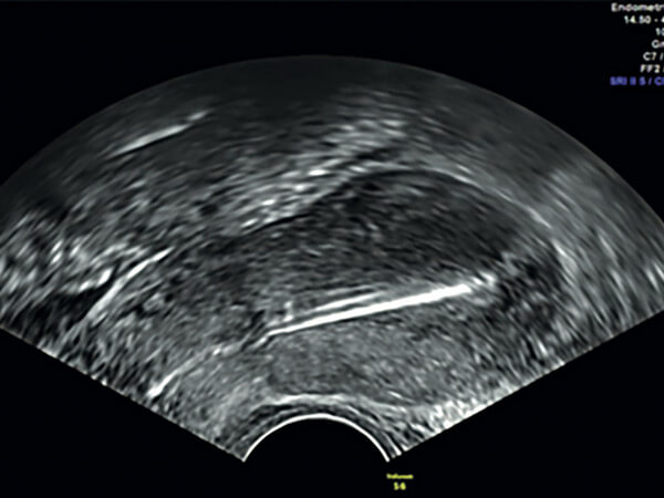 Gynäkologische Blickdiagnosen. Dislozierte Intrauterinspiralen – klinische Konsequenz?