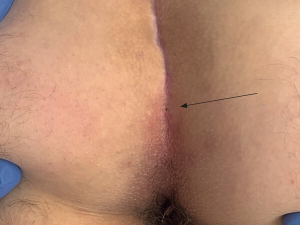 Pilonidalsinus – der Diodenlaserals neue minimal-invasive Therapieoption