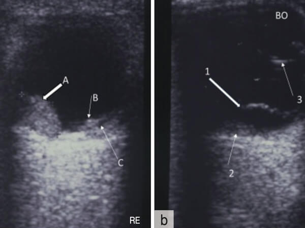 Forensische Pädopathologie: Retinale Blutungen bei Kindern nach Schütteltrauma