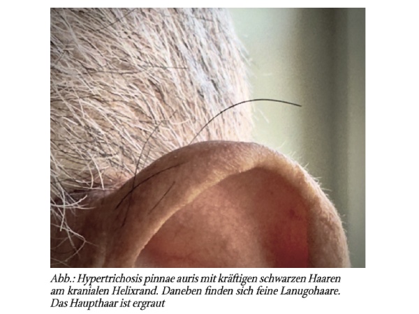Hypertrichosis pinnae auris