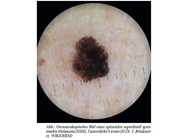 Schwierig zu diagnostizierende Melanome