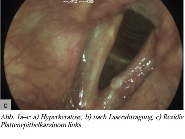 Die Computertomografie (CT)-basierte 3-dimensionale konformale Radiotherapie (3DCRT) bei T1a- Stimmlippenkarzinombei einem Chorsänger