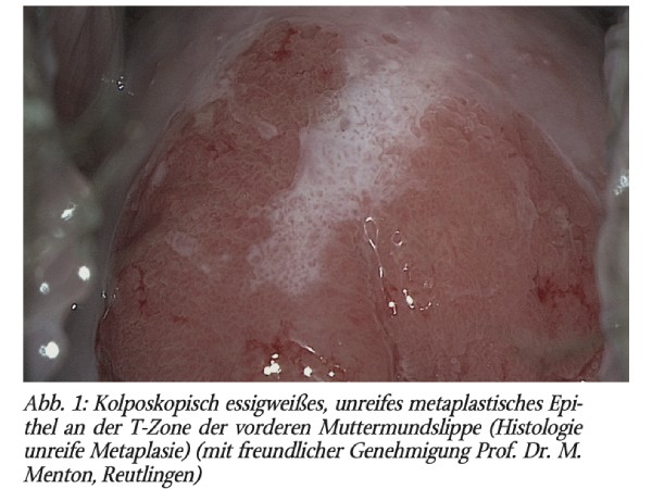Abklärungskolposkopie nach der Richtlinie des G-BA bei auffälligen Screening-Befunden mit den zytologischen Gruppen I, II-p und IIID1
