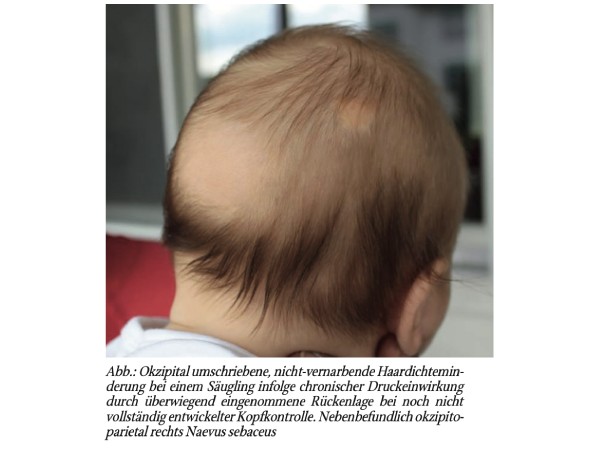 Säuglingsglatze: Eine besondere Formder traumatischen Alopezie