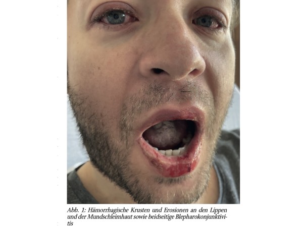 »Mycoplasma Pneumoniae- Induced Rash and Mucositis« (MIRM)