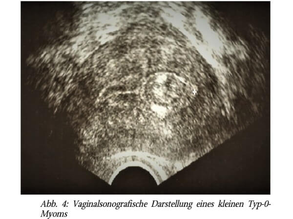 Die operative Hysteroskopie als Option für Patientinnen mit symptomatischen Myomen – eine praxisbezogene Übersicht