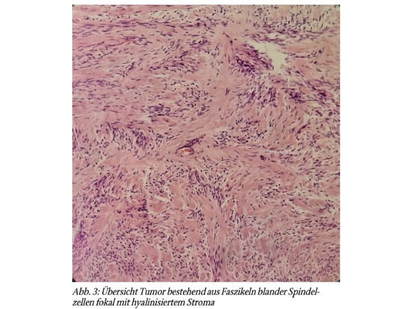 Das Meigs-Syndrom, eine seltene Differenzialdiagnose