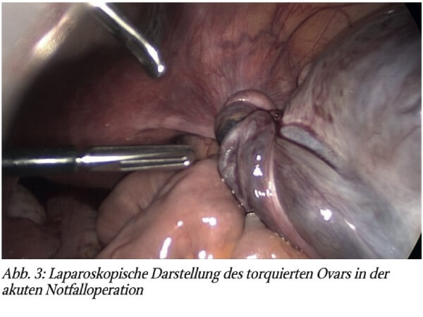 Akuter Unterbauchschmerz bei Frauen: Diagnostik und Management Beirat der schmerzhaften Ovarialzyste und Ovarialtorsion