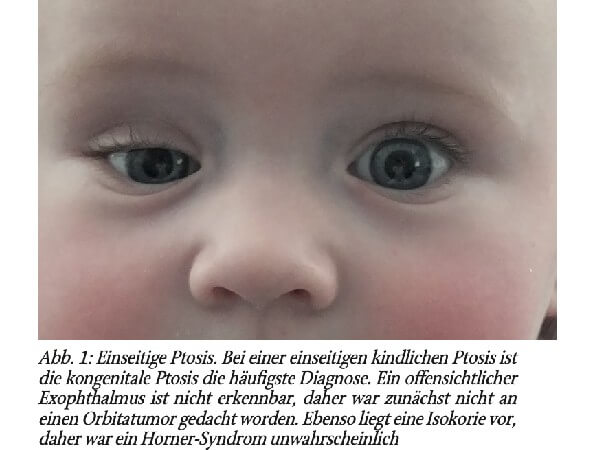 Simple angeborene Ptosis?
