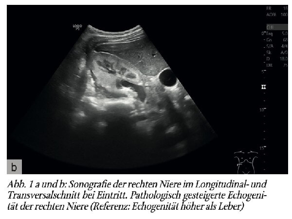 Schwere Niereninsuffizienz im Rahmen einer Malariainfektion bei jugendlicher Patientin