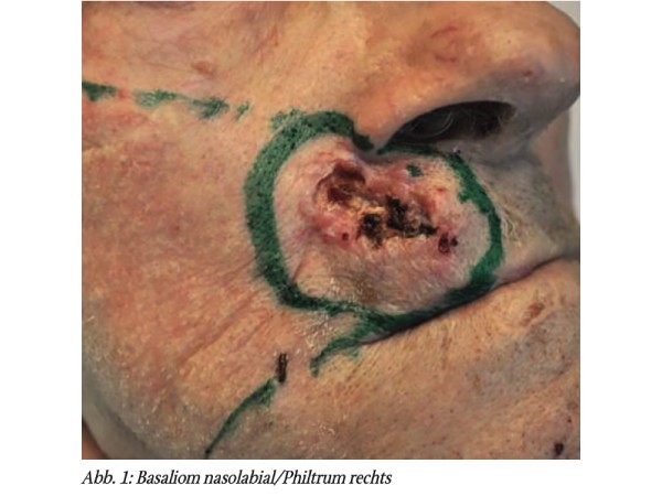Ausgedehntes Basaliom nasolabial/Philtrum rechts als operative Herausforderung