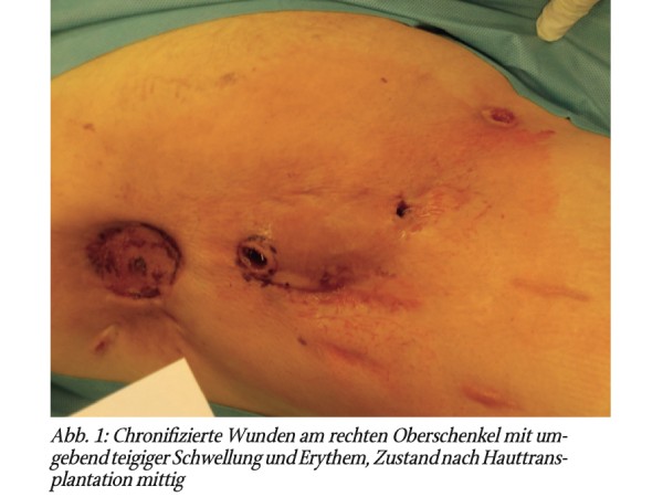 Die artifizielle Störung: Ein Fallbericht