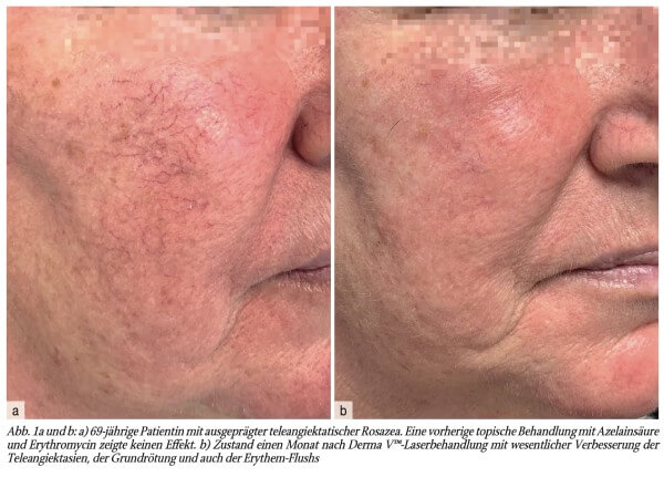 Rosazea-Therapie –State of the Art 2025