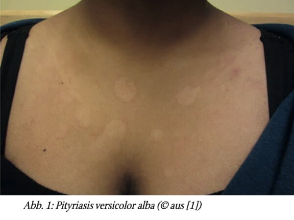 Kutane Hypopigmentierungen durch infektiöse Ursachen – eine Übersicht