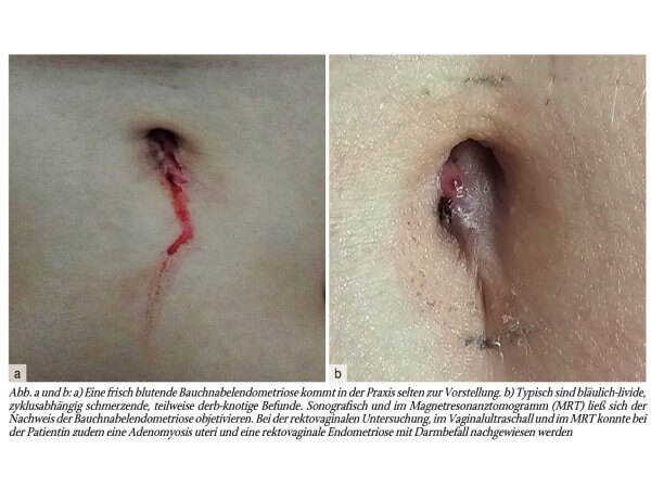 Gynäkologische Blickdiagnosen. Blutende Bauchnabelendometriose – was tun?