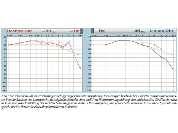 Fallbericht: Lipidsenker-induzierte passagere auditive Wahrnehmungsstörung