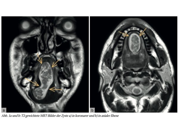 Ausgedehnter Tumor des Mundbodens – intralinguale Dermoidzyste, die eine Ductus-thyreoglossus-Zyste imitiert