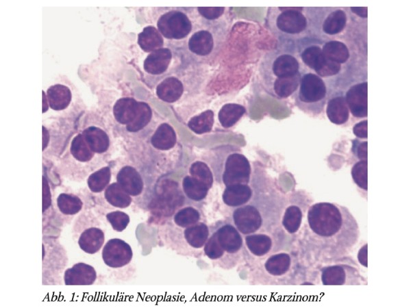 Zytologie der Schilddrüse: Möglichkeiten und Grenzen