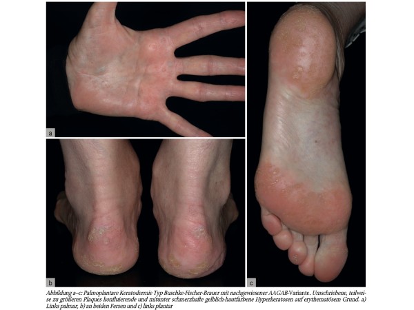 Genodermatosen – Eine Weiterbildungsreihe Teil 1. PPKs, Basalzellnävus-Syndrom und Genodermatosen mit renalen Symptomen