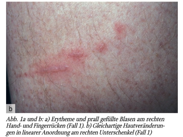 Gefahr am Wegesrand – Phytophotodermatitis durch Kontakt mit Bärenklau