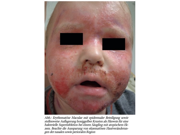 Atopische Dermatitis im Säuglingsalter – bakterielle Superinfektion als Komplikation