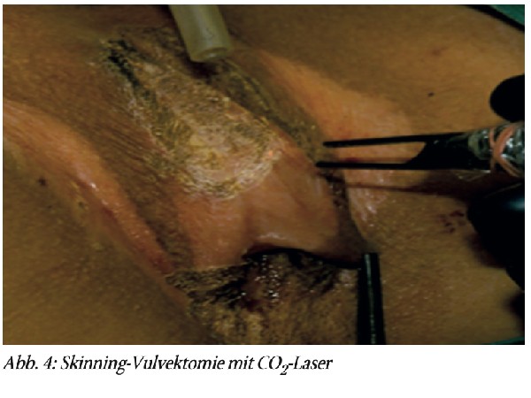 Dyspareunie – »Schmerzen bei der schönsten Sache der Welt«