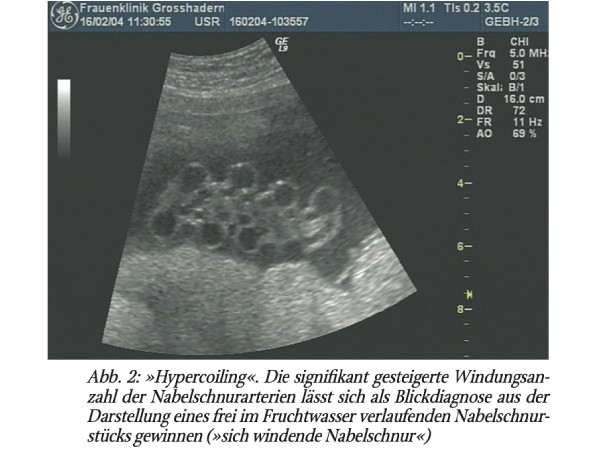 Die Nabelschnur – lebensstiftend,aber auch lebensgefährlich